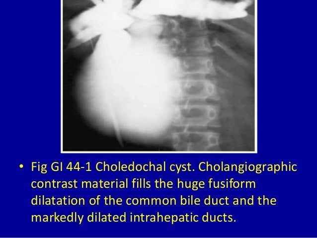 what does a dilated common bile duct mean what does a dilated common bile duct mean