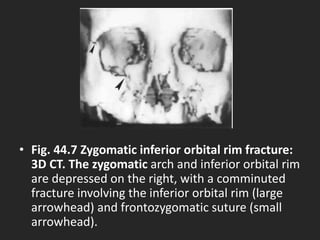 Zygomatic Rim 44 DAVID SUTTON PICTURES SKELETAL TRAUMA REGIONAL | PPTX