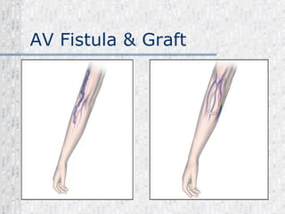 AV Fistula & Graft 