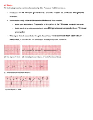 AV Blocks
AV block is diagnosed by examining the relationship of the P waves to the QRS complexes.


       First degree:   The PR interval is greater than 0.2 seconds; all beats are conducted through to the

       ventricles.

       Second degree:    Only some beats are conducted through to the ventricles.

           o   Mobitz type I (Wenckebach): Progressive    prolongation of the PR interval until a QRS is dropped

           o   Mobitz type II: All-or-nothing conduction, in which QRS   complexes are dropped without PR interval

               prolongation

       Third degree: No beats are conducted through to the ventricles. There   is complete heart block with AV

       dissociation, in which the atria and ventricles are driven by independent pacemakers.
 