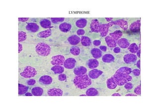 LYMPHOME
 