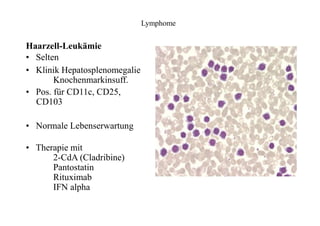 Lymphome
Haarzell-Leukämie
• Selten
• Klinik Hepatosplenomegalie
Knochenmarkinsuff.
• Pos. für CD11c, CD25,
CD103
• Normale Lebenserwartung
• Therapie mit
2-CdA (Cladribine)
Pantostatin
Rituximab
IFN alpha
 