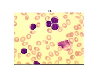CLL
 