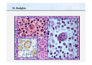 M. Hodgkin
CD30
 