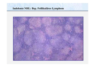 Indolente NHL: Bsp. Follikuläres Lymphom
 