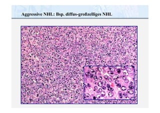 Aggressive NHL: Bsp. diffus-großzelliges NHL
 