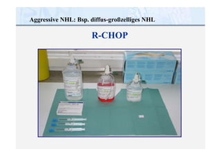 Aggressive NHL: Bsp. diffus-großzelliges NHL
R-CHOP
 