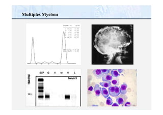 Multiples Myelom
 