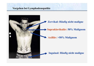 Vorgehen bei Lymphadenopathie
Zervikal: Häufig nicht maligne
Supraklavikulär: 50% Malignom
Axillär: >50% Malignom
Inguinal: Häufig nicht maligne
 