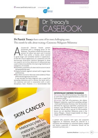 S K I N / D E R M AT O L O G Y
45Aesthetic Medicine • July/August 2015
SPONSORED BY CASE FILESwww.aestheticmed.co.uk
Dr Patrick Treacy shares some of his most challenging cases.
This month he talks about treating s Cutaneous Malignant Melanoma
Dr Treacy’s
CASEBOOK
A
23-year-old Siberian female patient
presented with a changing lesion on her
abdomen. The patient stated the lesion was
present for about two years and it started
off from within a freckle, which started
to grow larger and somewhat darken in appearance.
It had the clinical appearance of a melanoma and the
dermoscopy three-point checklist (designed to allow
non-experts not to miss detection of melanomas) was
used to determine whether this had a high likelihood of
malignancy. It included:
Asymmetry: asymmetry of colour and structure in one or
two perpendicular axes
Atypical network: pigment network with irregular holes
and thick lines
Blue-white structures: there was some evidence of blue-
white veil and regression structures
It was decided the likely diagnosis was a superficial
spreading melanoma and to remove the lesion with a
1cm clearance and work in association with a multi-
disciplinary team. However, it is recommended that
a patient who presents with signs and symptoms
suggestive of melanoma should be referred to a
consultant dermatologist or consultant plastic surgeon
and lesions suspicious of melanoma should not be
removed in primary care. 
HISTOPATHOLOGY CONFIRMED THE DIAGNOSIS
Macroscopy: Skin, left inframammary: Skin ellipse, 15 x
9 x 3mm with irregular pigmented lesion, 5 x 7mm, 1cm
from nearest margin.
Microscopy: Skin, left infra-mammary, skin ellipse:
Malignant melanoma, superficial spreading subtype
- Clark level III. Breslow thickness: 1mm. No ulceration
identified No regression identified. Lymphovascular
invasion is not identified. Perineural invasion is not
identified. Mitotic rate is two per 10. Microsatellite
lesions are not identified. Melanoma arises in the
naevus. Margins: - Closest margin (radial): 1cm. Deep
margin: 4mm Prof K Sheahan
 