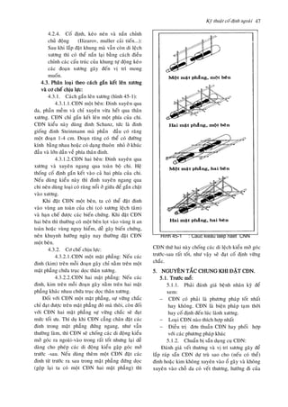 Kyõ thuaät coá ñònh ngoaøi 47
4.2.4. Coá ñònh, keùo neùn vaø naén chænh
chuû ñoäng (Ilizarov, muller caûi tieán...):
Sau khi laép ñaët khung maø vaãn coøn di leäch
xöông thì coù theå naén laïi baèng caùch ñieàu
chænh caùc caáu truùc cuûa khung töï ñoäng keùo
caùc ñoaïn xöông gaõy ñeán vò trí mong
muoán.
4.3. Phaân loaïi theo caùch gaén keát leân xöông
vaø cô cheá chòu löïc:
4.3.1. Caùch gaén leân xöông (hình 45-1):
4.3.1.1.CÑN moät beân: Ñinh xuyeân qua
da, phaàn meàm vaø chæ xuyeân vöøa heát qua thaân
xöông. CÑN chæ gaén keát leân moät phía cuûa chi.
CÑN kieåu naøy duøng ñinh Schanz, töùc laø ñinh
gioáng ñinh Steinmann maø phaàn ñaàu coù raêng
moät ñoaïn 1-4 cm. Ñoaïn raêng coù theå coù ñöôøng
kính baèng nhau hoaëc coù daïng thuoân nhoû ôû khuùc
ñaàu vaø lôùn daàn veà phía thaân ñinh.
4.3.1.2.CÑN hai beân: Ñinh xuyeân qua
xöông vaø xuyeân ngang qua toaøn boä chi. Heä
thoáng coá ñònh gaén keát vaøo caû hai phía cuûa chi.
Neáu duøng kieåu naøy thì ñinh xuyeân ngang qua
chi neân duøng loaïi coù raêng noåi ôû giöõa ñeå gaén chaët
vaøo xöông.
Khi ñaët CÑN moät beân, ta coù theå ñaët ñinh
vaøo vuøng an toaøn cuûa chi (coù xöông leäch taâm)
vaø haïn cheá ñöôïc caùc bieán chöùng. Khi ñaët CÑN
hai beân thì thöôøng coù moät beân loït vaøo vuøng ít an
toaøn hoaëc vuøng nguy hieåm, deã gaây bieán chöùng,
neân khuynh höôùng ngaøy nay thöôøng ñaët CÑN
moät beân.
4.3.2. Cô cheá chòu löïc:
4.3.2.1.CÑN moät maët phaúng: Neáu caùc
ñinh (kim) treân moãi ñoaïn gaõy chæ naèm treân moät
maët phaúng chöùa truïc doïc thaân xöông.
4.3.2.2.CÑN hai maët phaúng: Neáu caùc
ñinh, kim treân moãi ñoaïn gaõy naèm treân hai maët
phaúng khaùc nhau chöùa truïc doïc thaân xöông.
Ñoái vôùi CÑN moät maët phaúng, söï vöõng chaéc
chæ ñaït ñöôïc treân maët phaúng ñoù maø thoâi, coøn ñoái
vôùi CÑN hai maët phaúng söï vöõng chaéc seõ ñaït
möùc toái öu. Thí duï khi CÑN caúng chaân ñaët caùc
ñinh trong maët phaúng ñöùng ngang, nhö vaãn
thöôøng laøm, thì CÑN seõ choáng caùc di ñoäng kieåu
môû goùc ra ngoaøi-vaøo trong raát toát nhöng laïi deã
daøng cho pheùp caùc di ñoäng kieåu gaäp goùc môû
tröôùc -sau. Neáu duøng theâm moät CÑN ñaët caùc
ñinh töø tröôùc ra sau trong maët phaúng ñöùng doïc
(goäp laïi ta coù moät CÑN hai maët phaúng) thì
CÑN thöù hai naøy choáng caùc di leäch kieåu môû goùc
tröôùc-sau raát toát, nhö vaäy seõ ñaït coá ñònh vöõng
chaéc.
5. NGUYEÂN TAÉC CHUNG KHI ÑAËT CÑN.
5.1. Tröôùc moå:
5.1.1. Phaûi ñaùnh giaù beänh nhaân kyõ ñeå
xem:
 CÑN coù phaûi laø phöông phaùp toát nhaát
hay khoâng. CÑN laø bieän phaùp taïm thôøi
hay coá ñònh ñeán luùc laønh xöông.
 Loaïi CÑN naøo thích hôïp nhaát
 Ñieàu trò ñôn thuaàn CÑN hay phoái hôïp
vôùi caùc phöông phaùp khaùc
5.1.2. Chuaån bò saün duïng cuï CÑN:
Ñaùnh giaù veát thöông vaø vò trí xöông gaõy ñeå
laép raùp saün CÑN döï truø sao cho (neáu coù theå)
ñinh hoaëc kim khoâng xuyeân vaøo oå gaõy vaø khoâng
xuyeân vaøo choã da coù veát thöông, höôùng ñi cuûa
Hình 45-1 : Caùc kieåu laép ñaët CÑN
 