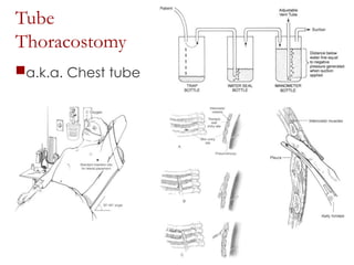 Chest Tubes Rotoprone 451725480-65478793-Pneumothorax-Final-ppt.ppt