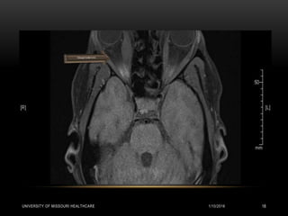 1/10/2016UNIVERSITY OF MISSOURI HEALTHCARE 18
 