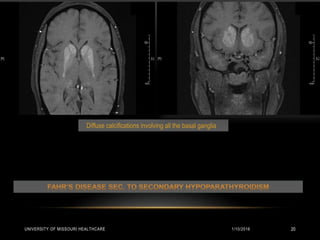 1/10/2016UNIVERSITY OF MISSOURI HEALTHCARE 20
Diffuse calcifications involving all the basal ganglia
 