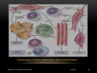 Pathophysiology of Grave’s opthalmopathy: Role of Orbital fibroblast
1/10/2016UNIVERSITY OF MISSOURI HEALTHCARE 22
 