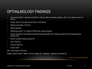 OPTHALMOLOGY FINDINGS
• Visual acuity 20/25- in right eye and 20/30+ in left eye, Mild to moderate proptosis, IOP is 14 in right eye and 13 in
left eye.
• Hertels: 25mm in the right eye and 23mm in the left eye.
• Ishihara color plates: 15/15 OU
• Mild lid retraction
• Sclera/Conjunctiva: 1-2+ injection OD>OS near muscle insertions
• Cornea: No edema, few scattered Superficial punctate keratitis OU, moderate dryness OU with decreased Tear
break up time
• Anterior chamber: Deep and quiet OU
• Lens: Clear OU
• Vitreous: Clear OU
• Fundus exam:
Disk: crisp margins 0.4C:D OU
Vessels: appear healthy : Macula: Flat and healthy OU : Peripheral : attached and healthy OU
1/10/2016UNIVERSITY OF MISSOURI HEALTHCARE 9
Courtesy: Dr. Wilson from Ophthalmology.
 