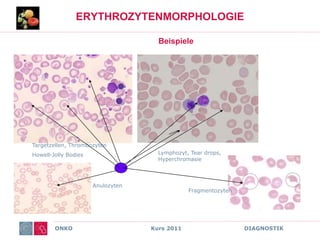 ONKO Kurs 2011 DIAGNOSTIK
ERYTHROZYTENMORPHOLOGIE
Beispiele
Targetzellen, Thrombozyten
Howell-Jolly Bodies Lymphozyt, Tear drops,
Hyperchromasie
Anulozyten
Fragmentozyten
 