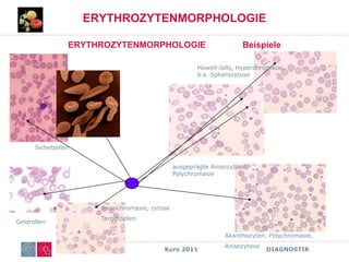 ONKO Kurs 2011 DIAGNOSTIK
ERYTHROZYTENMORPHOLOGIE
ERYTHROZYTENMORPHOLOGIE Beispiele
Sichelzellen
Geldrollen
Howell-Jolly, Hyperchromasie,
V.a. Sphärozytose
ausgeprägte Anisozytose,
Polychromasie
Anisochromasie, zytose
Targetzellen
Akanthozyten, Polychromasie,
Anisozytose
 
