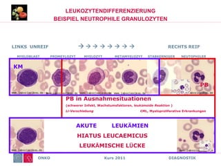 ONKO Kurs 2011 DIAGNOSTIK
LEUKOZYTENDIFFERENZIERUNG
BEISPIEL NEUTROPHILE GRANULOZYTEN
PB in Ausnahmesituationen
(schwerer Infekt, Wachstumsfaktoren, leukämoide Reaktion )
Li-Verschiebung CML, Myeloproliferative Erkrankungen
LINKS UNREIF         RECHTS REIF
MYELOBLAST PROMEYLOZYT MYELOZYT METAMYELOZYT STABKERNIGER NEUTOPHILER
PB
KM
AKUTE LEUKÄMIEN
HIATUS LEUCAEMICUS
LEUKÄMISCHE LÜCKE
 