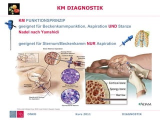 ONKO Kurs 2011 DIAGNOSTIK
KM DIAGNOSTIK
KM PUNKTIONSPRINZIP
geeignet für Beckenkammpunktion, Aspiration UND Stanze
Nadel nach Yamshidi
geeignet für Sternum/Beckenkamm NUR Aspiration
 
