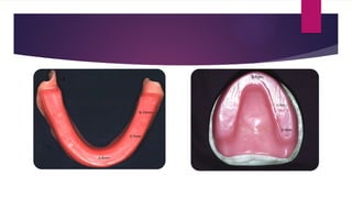 Oclusal Rim 455866711-Occlusal-Rim and recordd bases.pptx