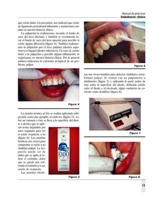 Manual de prácticas
Endodoncia clínica
13
que exista dolor a la percusión, nos indicará que existe
un ligamento periodontal inflamado y anotaremos este
dato en nuestra historia clínica.
La palpación la realizaremos tocando el fondo de
saco del área afectada, y también se recomienda to-
car el fondo de saco del área opuesta para percibir si
existe alguna diferencia (figura 4). También realizare-
mos la palpación por el área palatina (dientes supe-
riores) o lingual (dientes inferiores). En caso de existir
dolor a la palpación o percibir alguna inflamación, lo
registramos en nuestra historia clínica. Por lo general
pudiera indicarnos la extensión periapical de un pro-
blema pulpar.
La prueba térmica al frío se realiza aplicando refri-
gerante como por ejemplo: el endo-ice (figura 5), so-
bre un cotonete y éste se lleva a la superficie del dien-
te o dientes que se quie-
ran testar dejándolo por
unos segundos para ver
si existe respuesta o no
(figura 6). Las pruebas
térmicas nos sirven para
comprobar si existe o no
vitalidad pulpar. La res-
puesta puede ser de
dolor que se quita al re-
tirar el estímulo, dolor
que se queda aun reti-
rando el estímulo y/o au-
sencia de respuesta.
Las pruebas eléctri-
cas nos sirven también para detectar vitalidad o sensi-
bilidad pulpar. Se realiza con un pulpómetro o
vitalómetro (figura 7) y aplicando la parte activa de
éste sobre la superficie del diente, debiendo existir,
entre el diente y el electrodo, algún conductor de co-
rriente como dentífrico (figura 8).
Figura 5
Figura 7
Figura 8
Figura 4
Figura 6
 