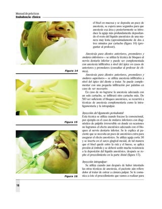 Manual de prácticas
Endodoncia clínica
16
el bisel en mucosa y se deposita un poco de
anestesia, se espera unos segundos para que
anestesie esa área y posteriormente se intro-
duce la aguja más profundamente depositan-
do el resto del líquido anestésico de una ma-
nera muy lenta (aproximadamente de dos a
tres minutos por cartucho (figura 16) (pre-
guntar al profesor).
Anestesia para dientes anteriores, premolares y
molares inferiores— se utiliza la técnica de bloqueo al
nervio dentario inferior y puede ser complementada
con anestesia infiltrativa a nivel del ápice en casos de
anteriores y premolares (consultar al profesor de clí-
nica).
Anestesia para dientes anteriores, premolares y
molares superiores— se utiliza anestesia infiltrativa a
nivel del ápice del diente a tratar. Se puede comple-
mentar con una pequeña infiltración por palatino en
caso de ser necesario.
En caso de no lograrse la anestesia adecuada con
un solo cartucho, se infiltrará otro cartucho más. De
NO ser suficiente el bloqueo anestésico, se recurrirá a
técnicas de anestesia complementaria como la intra-
ligamentaria y la intrapulpar.
Inyección del ligamento periodontal:
Esta técnica se utiliza cuando fracase la convencional,
por ejemplo en el caso de molares inferiores con diag-
nóstico de pulpitis irreversible en donde en ocasiones
no logramos el efecto anestésico adecuado con el blo-
queo al nervio dentario inferior. Se le explica al pa-
ciente que se necesita un poco de anestésico extra para
asegurar el efecto anestésico. Se utiliza aguja corta 30
y se inserta en el surco gingival mesial, de tal manera
que el bisel quede entre la raíz y el hueso, se aplica
presión al émbolo y se deberá sentir mucha resistencia
a la deposición del líquido anestésico, después se re-
pite el procedimiento en la parte distal (figura 17).
Inyección intrapulpar:
Se utiliza cuando aun después de haber intentado
las otras técnicas de anestesia, el paciente aún refiere
dolor al tratar de entrar a cámara pulpar. Se le comu-
nica a éste el procedimiento que vamos a realizar para
Figura 15
Figura 14
Figura 16
 