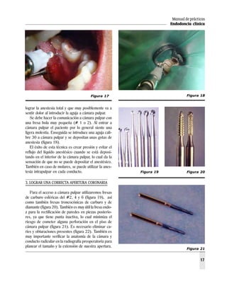 Manual de prácticas
Endodoncia clínica
17
lograr la anestesia total y que muy posiblemente va a
sentir dolor al introducir la aguja a cámara pulpar.
Se debe hacer la comunicación a cámara pulpar con
una fresa bola muy pequeña (# 1 o 2). Al entrar a
cámara pulpar el paciente por lo general siente una
ligera molestia. Enseguida se introduce una aguja cali-
bre 30 a cámara pulpar y se depositan unas gotas de
anestesia (figura 18).
El éxito de esta técnica es crear presión y evitar el
reflujo del líquido anestésico cuando se está deposi-
tando en el interior de la cámara pulpar, lo cual da la
sensación de que no se puede depositar el anestésico.
También en caso de molares, se puede utilizar la anes-
tesia intrapulpar en cada conducto.
3. LOGRAR UNA CORRECTA APERTURA CORONARIA
Para el acceso a cámara pulpar utilizaremos fresas
de carburo esféricas del #2, 4 y 6 (figura 19), así
como también fresas troncocónicas de carburo y de
diamante (figura 20). También es muy útil la fresa endo-
z para la rectificación de paredes en piezas posterio-
res, ya que tiene punta inactiva, lo cual minimiza el
riesgo de cometer alguna perforación en el piso de
cámara pulpar (figura 21). Es necesario eliminar ca-
ries y obturaciones presentes (figura 22). También es
muy importante verificar la anatomía de la cámara y
conducto radicular en la radiografía preoperatoria para
planear el tamaño y la extensión de nuestra apertura.
Figura 18
Figura 20Figura 19
Figura 21
Figura 17
 