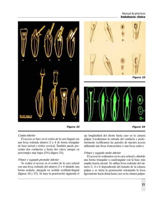 Manual de prácticas
Endodoncia clínica
21
Canino inferior
El acceso se hace en el centro de la cara lingual con
una fresa redonda número 2 o 4 de forma triangular
de base incisal y vértice cervical. También puede pre-
sentar dos conductos y hasta dos raíces aunque en
porcentajes muy bajos (5%) (figura 35).
Primer y segundo premolar inferior
Se realiza el acceso en el centro de la cara oclusal
con una fresa redonda del número 2 o 4 dándole una
forma ovalada, alargada en sentido vestíbulo-lingual
(figuras 36 y 37). Se hace la penetración siguiendo el
eje longitudinal del diente hasta caer en la cámara
pulpar. Localizamos la entrada del conducto y poste-
riormente rectificamos las paredes de nuestro acceso
utilizando una fresa troncocónica o una fresa endo-z.
Primer y segundo molar inferior
El acceso lo realizamos en la cara oclusal y dándole
una forma triangular o cuadrangular con la base más
amplia hsacia mesial. Se utiliza fresa redonda del nú-
mero 2, 4 o 6 dependiendo del tamaño de la cámara
pulpar y se inicia la penetración orientando la fresa
ligeramente hacia distal hasta caer en la cámara pulpar.
Figura 32 Figura 34
Figura 33
 