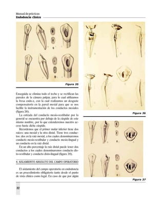Manual de prácticas
Endodoncia clínica
22
Enseguida se elimina todo el techo y se rectifican las
paredes de la cámara pulpar, para lo cual utilizamos
la fresa endo-z, con la cual realizamos un desgaste
compensatorio en la pared mesial para que se nos
facilite la instrumentación de los conductos mesiales
(figura 38).
La entrada del conducto mesio-vestibular por lo
general se encuentra por debajo de la cúspide de este
mismo nombre, por lo que extenderemos nuestro ac-
ceso hasta dicha cúspide.
Recordemos que el primer molar inferior tiene dos
raíces: una mesial y la otra distal. Tiene tres conduc-
tos: dos en la raíz mesial, a los cuales denominaremos
conducto mesio-vestibular y conducto mesio-lingual y
un conducto en la raíz distal.
En un alto porcentaje la raíz distal puede tener dos
conductos a los cuales denominaremos conducto dis-
to-vestibular y conducto disto-lingual (figura 39).
4. AISLAMIENTO ABSOLUTO DEL CAMPO OPERATORIO
El aislamiento del campo operatorio en endodoncia
es un procedimiento obligatorio tanto desde el punto
de vista clínico como legal. En caso de que por algún
Figura 35
Figura 36
Figura 37
 