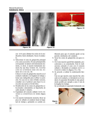 Manual de prácticas
Endodoncia clínica
34
con EDTA para eliminar los restos de la me-
dicación y barro dentinario. Secar el conduc-
to.
2. Seleccionar el cono de gutapercha principal
y los conos accesorios. El cono principal debe
corresponder al número del instrumento me-
moria, es decir, si nuestro instrumento me-
moria fue una lima NÚMERO 45, NUESTRO
CONO DE GUTAPERCHA SERÁ UNO DEL NÚ-
MERO 45 O UNO DEL 40.
Colocar el cono de gutapercha maestro en el
conducto radicular a la longitud de trabajo y
tomar una radiografía para verificar su posi-
ción. En caso de no estar al límite correcto,
consultar con el profesor para hacer la co-
rrección necesaria (CONOMETRÍA).
3. Desinfección de los conos de gutapercha se-
leccionados colocándolos en hipoclorito de
sodio durante 5 minutos.
4. Espatulado del cemento sellador HASTA OB-
TENER LA CONSISTENCIA DE HEBRA (figura
72).
5. Con nuestro instrumento memoria, llevar un
poco de sellador al conducto hasta la longi-
tud de trabajo y girándolo en sentido an-
tihorario para que el cemento quede en las
paredes dentinarias del conducto.
6. Secar los conos de gutapercha con gasa es-
téril.
7. Si el cono maestro quedó bien adaptado, pro-
cederemos a su cementación. Esto lo reali-
zaremos untando el cono con el cemento
sellador y llevándolo al conducto HASTA LA
POSICIÓN CORRECTA (figuras 73 y 74).
8. Se procede a realizar la condensación late-
ral.
Una vez que nuestro cono maestro fue colo-
cado en el conducto, se introducirá en el con-
ducto el espaciador llevándolo lo más apical-
mente posible por ejemplo a unos 2 mm de
la longitud de trabajo.
Se va retirando el espaciador lentamente con
Figura 70 Figura 71
Figura 72
Figura
73
 