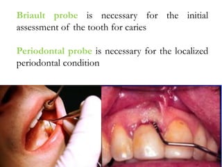 Briault probe is necessary for the initial
assessment of the tooth for caries
Periodontal probe is necessary for the localized
periodontal condition
 