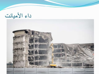 ‫األميانت‬ ‫داء‬
 