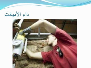 ‫األميانت‬ ‫داء‬
 