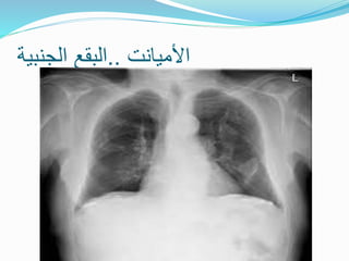 ‫األميانت‬
..
‫الجنبية‬ ‫البقع‬
 