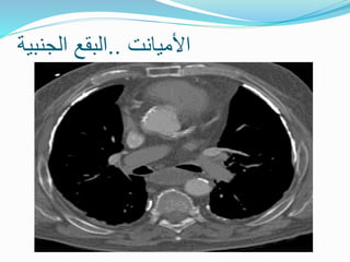 ‫األميانت‬
..
‫الجنبية‬ ‫البقع‬
 