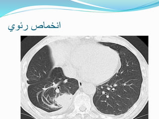 ‫رئوي‬ ‫انخماص‬
 