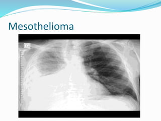 Mesothelioma
 