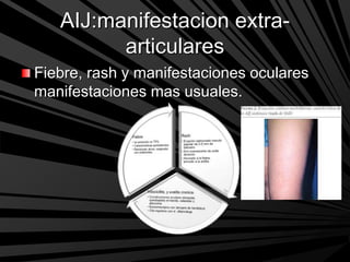 AIJ:manifestacion extra-
articulares
Fiebre, rash y manifestaciones oculares
manifestaciones mas usuales.
 