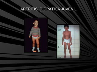 ARTRITIS IDIOPATICA JUVENIL
 