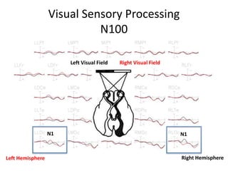 Visual Sensory Processing
N100
Left Hemisphere Right Hemisphere
N1 N1
Right Visual FieldLeft Visual Field
 