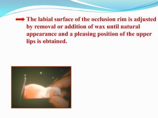 The labial surface of the occlusion rim is adjusted
by removal or addition of wax until natural
appearance and a pleasing position of the upper
lips is obtained.
 