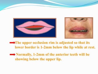 The upper occlusion rim is adjusted so that its
lower border is 1-2mm below the lip while at rest.
Normally, 1-2mm of the anterior teeth will be
showing below the upper lip.
 