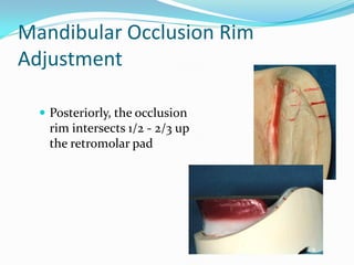 Mandibular Occlusion Rim
Adjustment
 Posteriorly, the occlusion
rim intersects 1/2 - 2/3 up
the retromolar pad
 