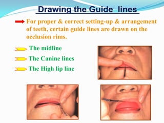 The midline
The Canine lines
The High lip line
For proper & correct setting-up & arrangement
of teeth, certain guide lines are drawn on the
occlusion rims.
 