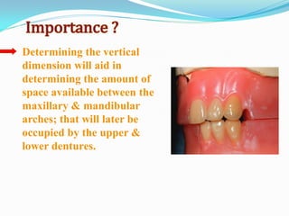 Determining the vertical
dimension will aid in
determining the amount of
space available between the
maxillary & mandibular
arches; that will later be
occupied by the upper &
lower dentures.
 