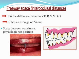 It is the difference between V.D.R & V.D.O.
It has an average of 2-4mm.
 Space between wax rims at
physiologic rest position
 