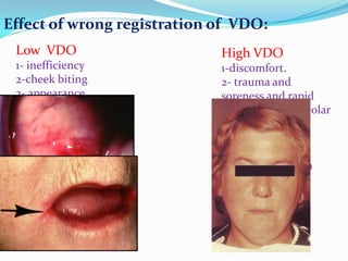 Effect of wrong registration of VDO:
Low VDO
1- inefficiency
2-cheek biting
3- appearance
4- soreness of the
corner of the mouth
5- pain in TMJ
6- lack of tongue
space
High VDO
1-discomfort.
2- trauma and
soreness and rapid
resorption of alveolar
bone
3- loss of free way
space
4-clicking of teeth
during speech
5- appearance
(elongated face)
6- difficulty in
swallowing
 