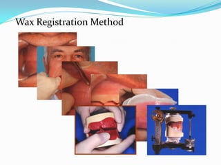 Wax Registration Method
 