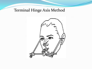 Terminal Hinge Axis Method
 